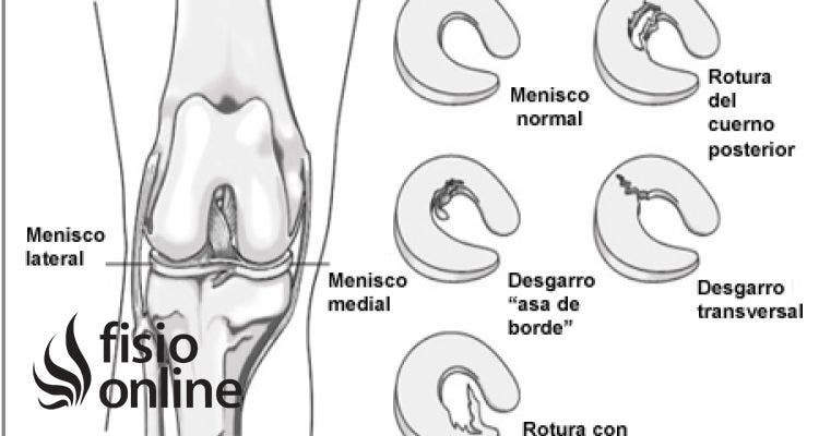 Rotura de menisco interno