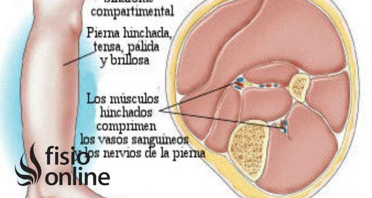 síndrome compartimental