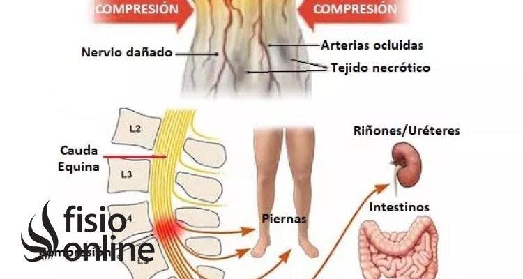 Síndrome de la cola de caballo