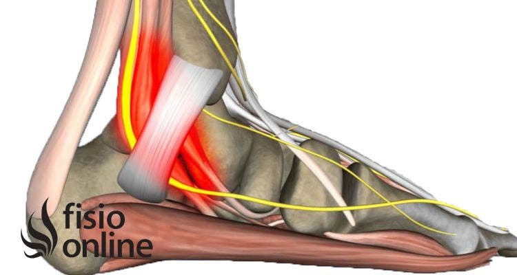 Sindrome del túnel del tarso
