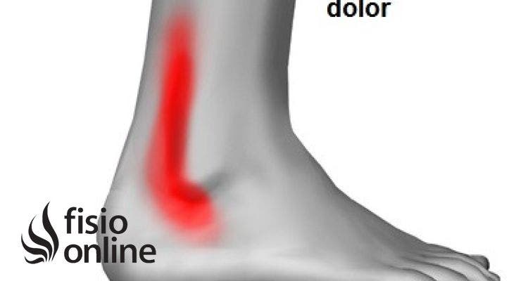 Tendinitis de los peroneos