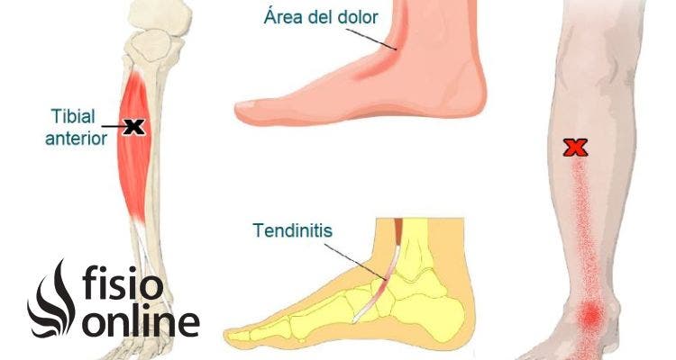 Tendinitis del tibial anterior
