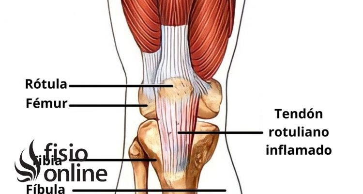 Tendinitis rotuliana