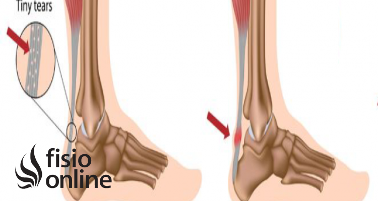 Tendinosis