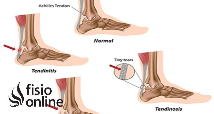 Tendón de Aquiles