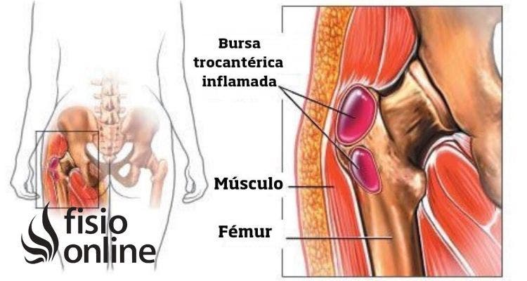 Trocanteritis - bursitis trocantérea