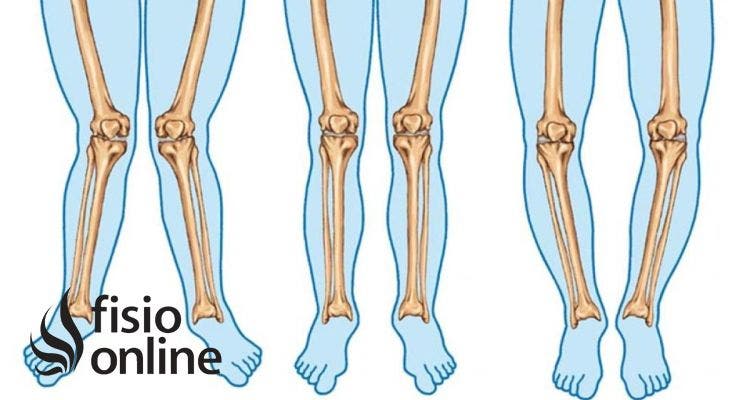 Valgo y varo de rodilla 