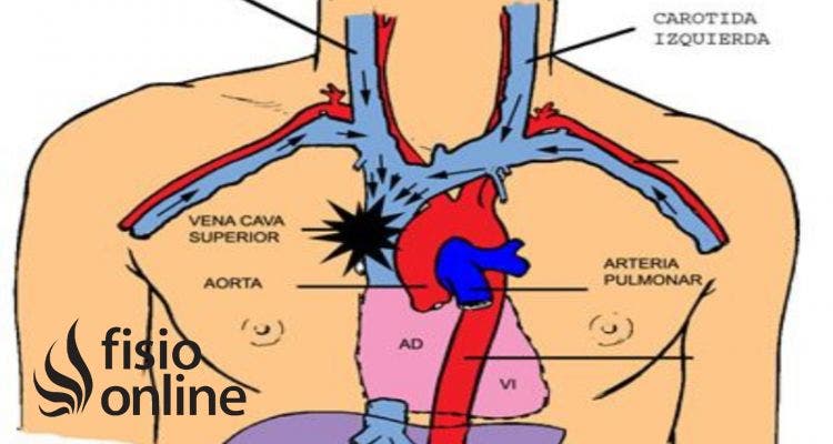 Vena cava superior