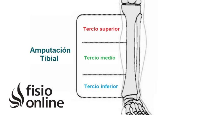 Amputación tibial