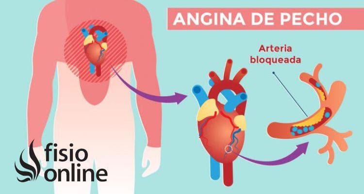 Angina de pecho