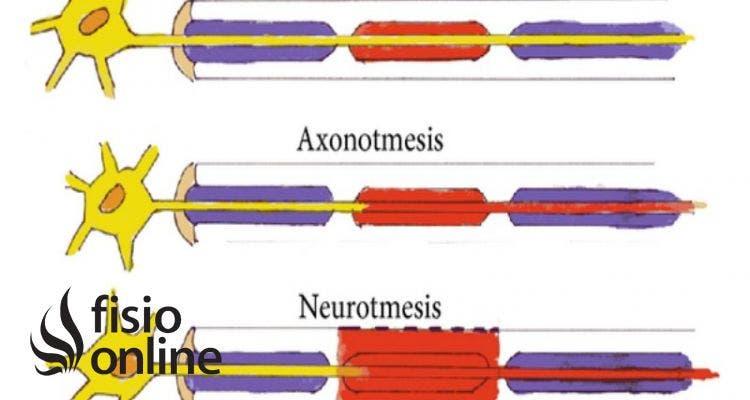 axonotmesis