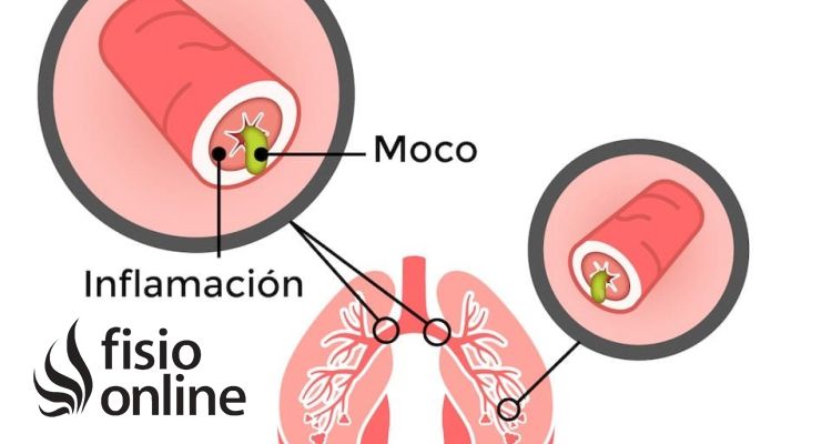 Bronquiolitis