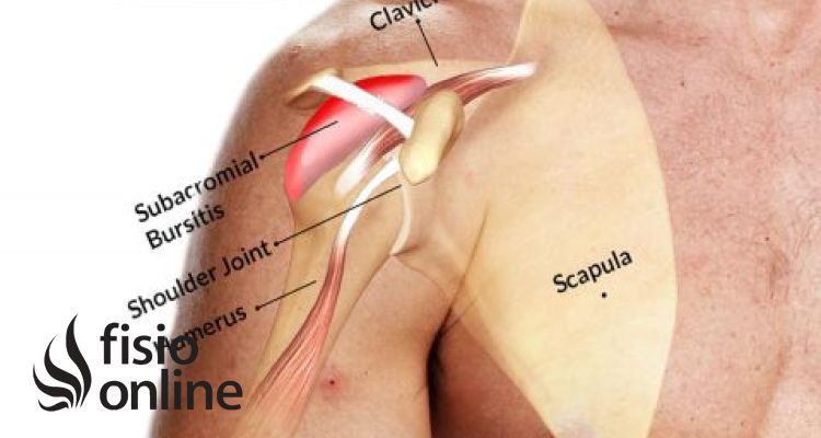 Bursitis de hombro