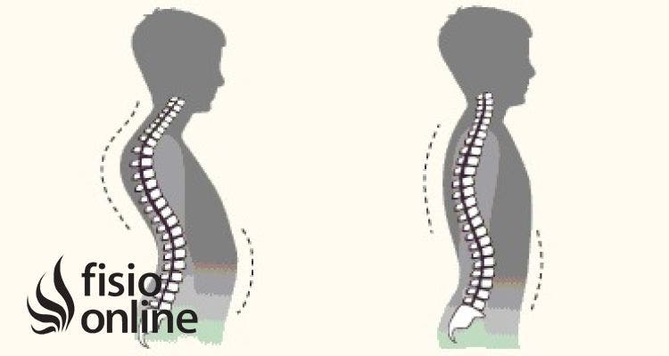 Cifosis dorsal 