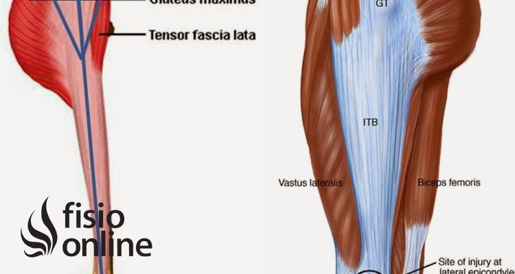 Tendinitis de la fascia lata 