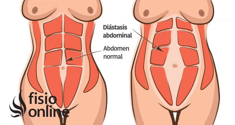 Diástasis de los rectos