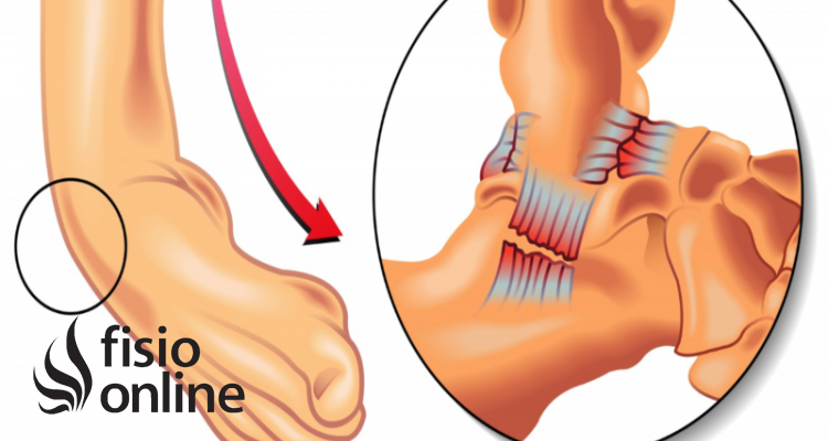 distensión de ligamentos