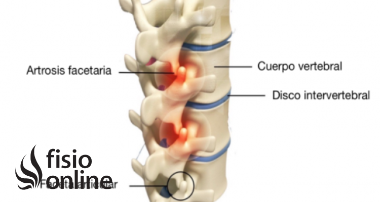 dolor facetario