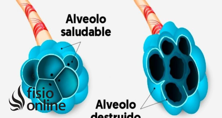 enfisema pulmonar