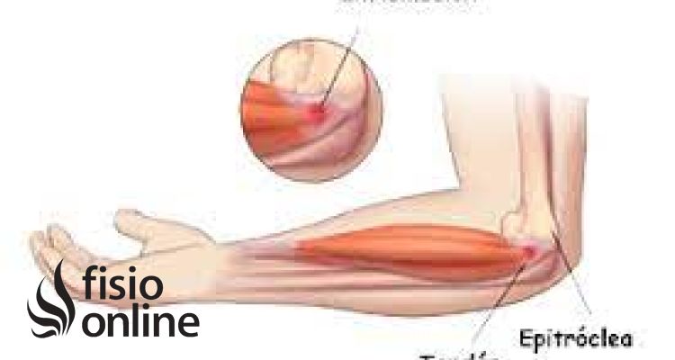 Epitrocleitis Epitrocleitis