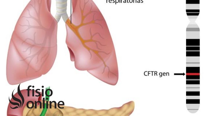Fibrosis quistica