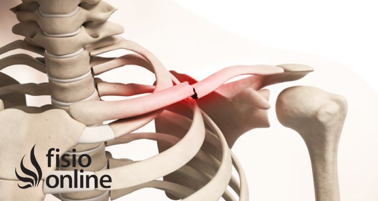 Fractura de clavicula Qué es, causas, sintomas y tratamiento