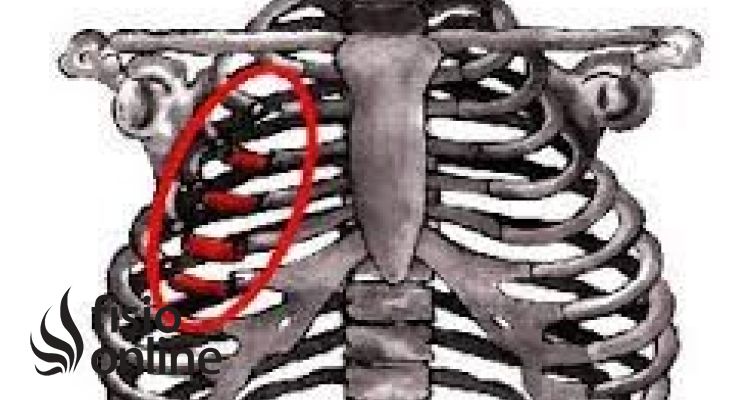 Fractura de costillas