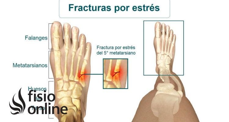 Fractura por estres 