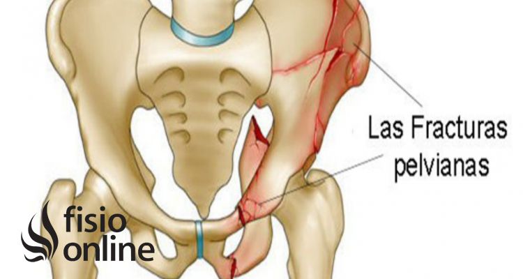 Fractura de pelvis