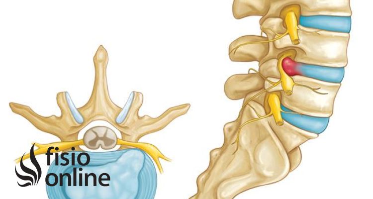 Hernia lumbar