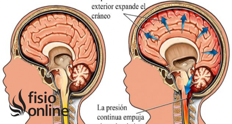 hidrocefalia