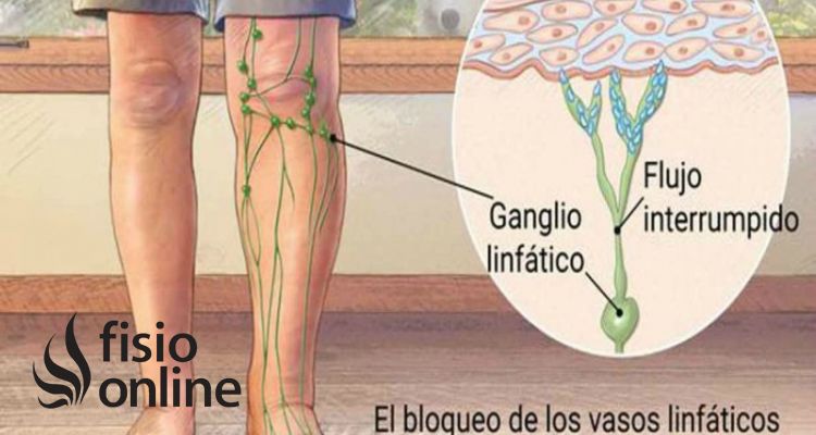 linfedema en niños