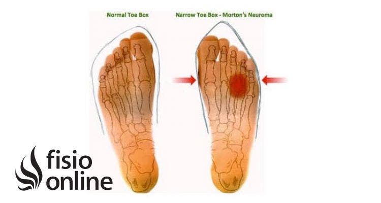 Neuroma de Morton