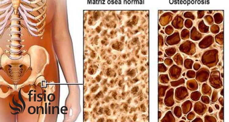 Osteoporósis