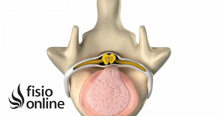 prolapso discal