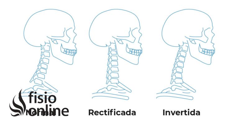 Rectificación cervical como dormir hotsell