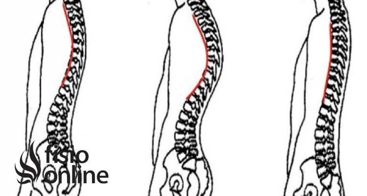 rectificación de columna vertebral