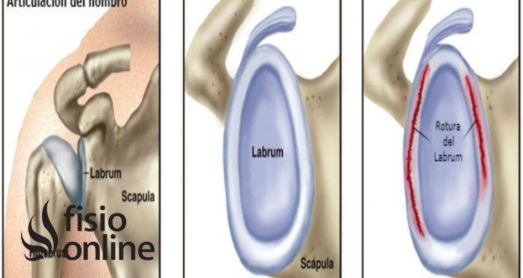 Rodete glenoideo o labrum 