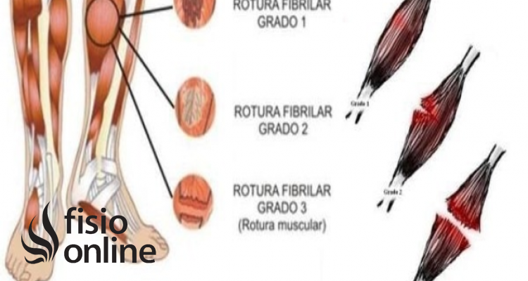 Rotura de fibras