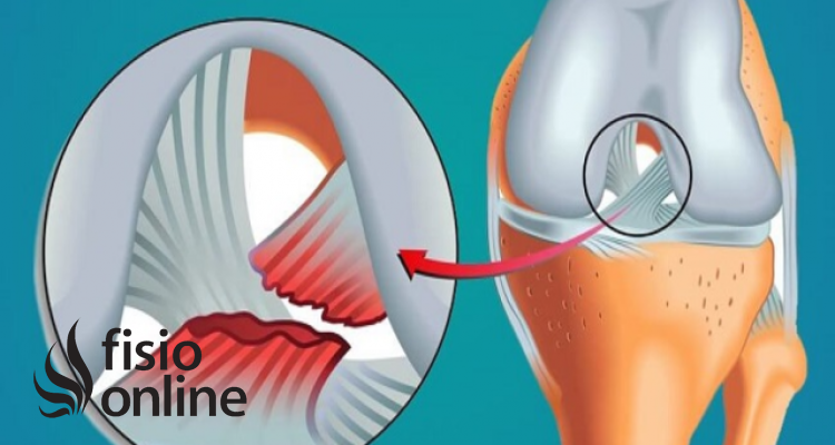 rotura de ligamentos