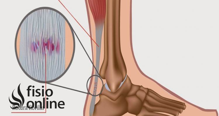rotura tendinosa