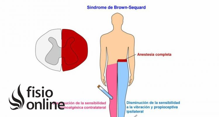 síndrome Brown Sequard