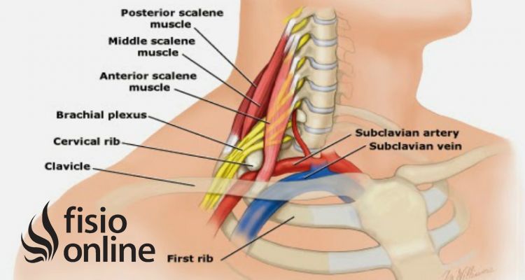 síndrome del escaleno