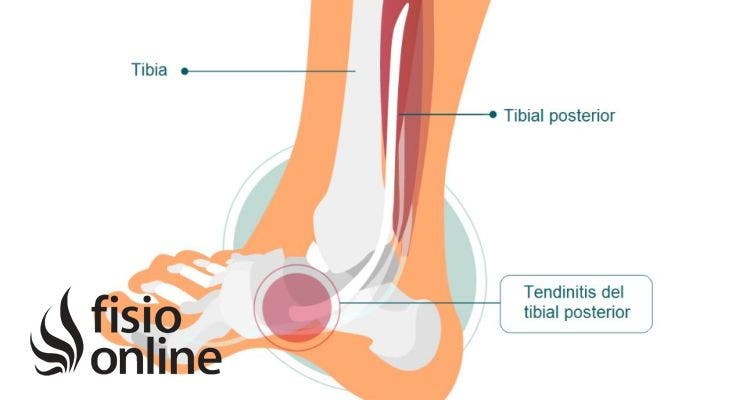 Tendinitis del tibial posterior