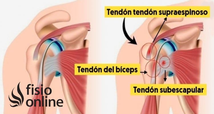 Tendón del Supraespinoso