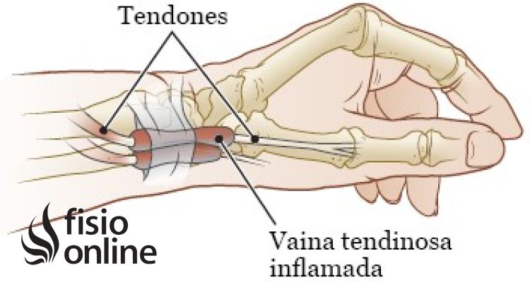 Tenosinovitis de De Quervain