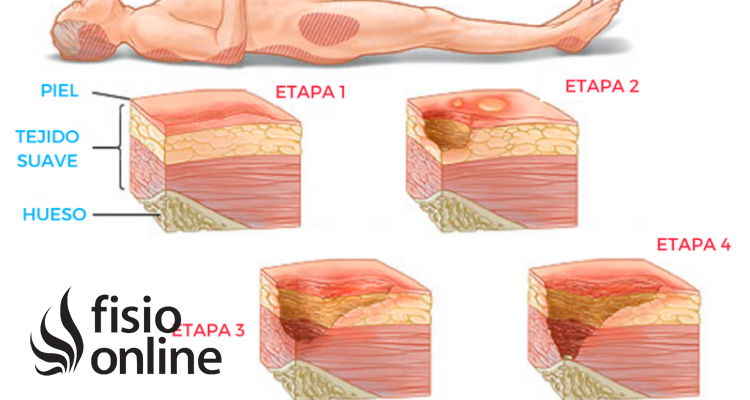 úlceras por presión
