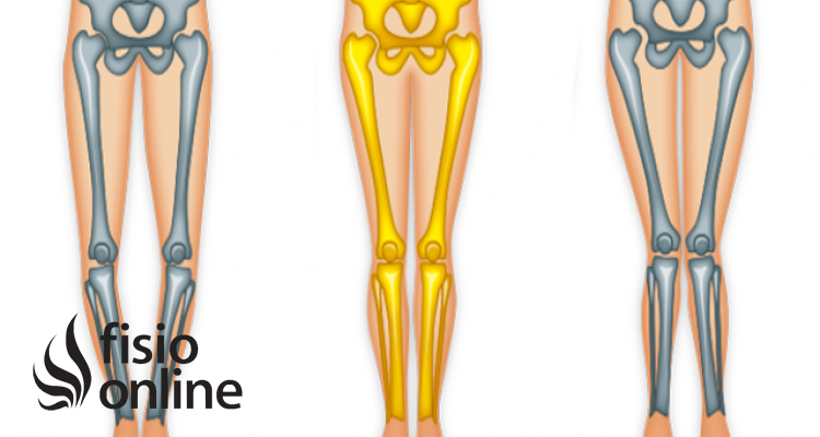 varo de rodilla