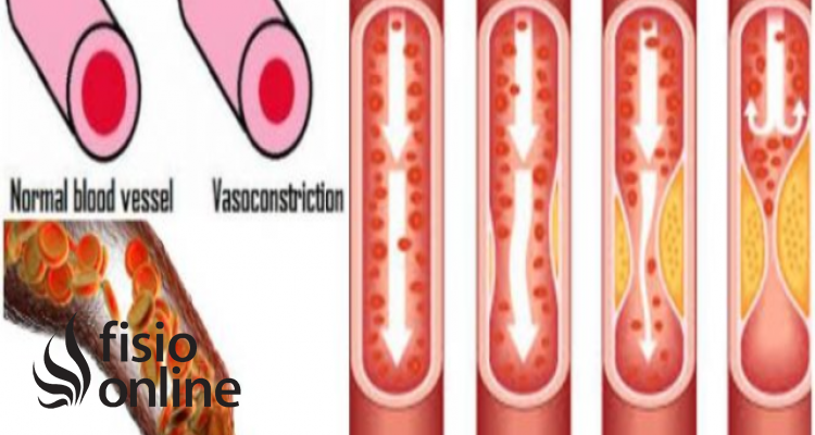 vasoconstricción