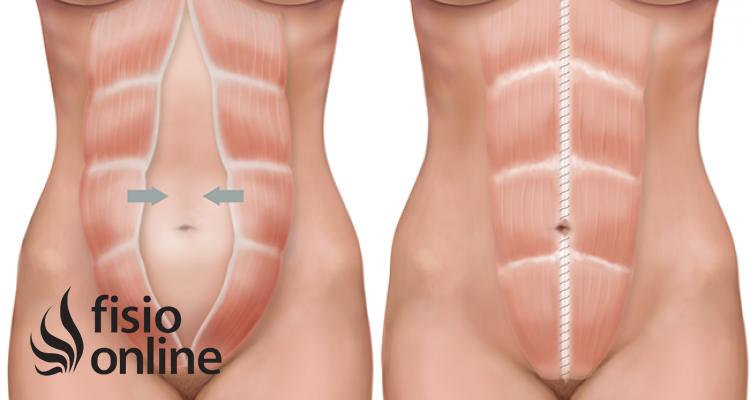 Diástasis de los rectos abdominales. Qué es y consejos para su cuidado